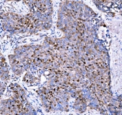 IHC staining of FFPE human lung cancer tissue with p57Kip2 antibody. HIER: boil tissue sections in pH8 EDTA for 20 min and allow to cool before testing.
