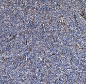 IHC staining of FFPE human skin cancer tissue with COL4A3 antibody. HIER: boil tissue sections in pH8 EDTA for 20 min and allow to cool before testing.