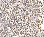 IHC staining of FFPE human pancreatic cancer tissue with c-Jun antibody. HIER: boil tissue sections in pH8 EDTA for 20 min and allow to cool before testing.