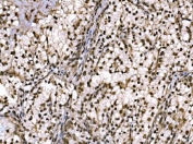 IHC staining of FFPE human renal clear cell carcinoma tissue with c-Jun antibody. HIER: boil tissue sections in pH8 EDTA for 20 min and allow to cool before testing.