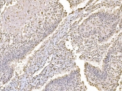 IHC staining of FFPE human laryngeal squamous cell carcinoma tissue with c-Jun antibody. HIER: boil tissue sections in pH8 EDTA for 20 min and allow to cool before testing.