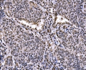 IHC staining of FFPE human lung cancer tissue with c-Jun antibody. HIER: boil tissue sections in pH8 EDTA for 20 min and allow to cool before testing.