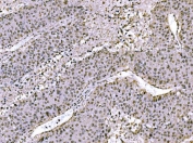 IHC staining of FFPE human liver cancer tissue with c-Jun antibody. HIER: boil tissue sections in pH8 EDTA for 20 min and allow to cool before testing.