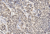 IHC staining of FFPE human lung cancer tissue with FUBP2 antibody. HIER: boil tissue sections in pH8 EDTA for 20 min and allow to cool before testing.