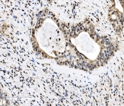 IHC staining of FFPE human gallbladder adenocarcinoma tissue with FUBP2 antibody. HIER: boil tissue sections in pH8 EDTA for 20 min and allow to cool before testing.