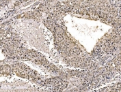 IHC staining of FFPE human liver cancer tissue with FUBP2 antibody. HIER: boil tissue sections in pH8 EDTA for 20 min and allow to cool before testing.
