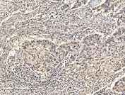 IHC staining of FFPE human laryngeal squamous cell carcinoma tissue with FUBP2 antibody. HIER: boil tissue sections in pH8 EDTA for 20 min and allow to cool before testing.