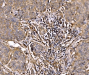 IHC staining of FFPE human lung cancer tissue with PIK3R1 antibody. HIER: boil tissue sections in pH8 EDTA for 20 min and allow to cool before testing.
