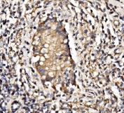 IHC staining of FFPE human testicular cancer tissue with PIK3R1 antibody. HIER: boil tissue sections in pH8 EDTA for 20 min and allow to cool before testing.