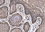 IHC staining of FFPE human esophageal squamous carcinoma tissue with CoREST antibody. HIER: boil tissue sections in pH8 EDTA for 20 min and allow to cool before testing.