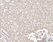 IHC staining of FFPE human lung cancer tissue with Recoverin antibody. HIER: boil tissue sections in pH8 EDTA for 20 min and allow to cool before testing.