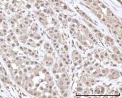 IHC staining of FFPE human breast cancer tissue with Recoverin antibody. HIER: boil tissue sections in pH8 EDTA for 20 min and allow to cool before testing.