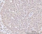 IHC staining of FFPE human ovarian cancer tissue with Recoverin antibody. HIER: boil tissue sections in pH8 EDTA for 20 min and allow to cool before testing.