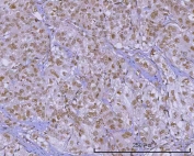 IHC staining of FFPE human urothelial carcinoma tissue with PRPF18 antibody. HIER: boil tissue sections in pH8 EDTA for 20 min and allow to cool before testing.