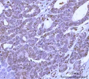 IHC staining of FFPE human ovary serous carcinoma tissue with PRPF18 antibody. HIER: boil tissue sections in pH8 EDTA for 20 min and allow to cool before testing.