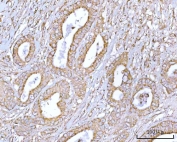 IHC staining of FFPE human colon adenocarcinoma tissue with RPS13 antibody. HIER: boil tissue sections in pH8 EDTA for 20 min and allow to cool before testing.