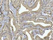 IHC staining of FFPE human prostate cancer tissue with RPS13 antibody. HIER: boil tissue sections in pH8 EDTA for 20 min and allow to cool before testing.