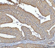 IHC staining of FFPE human endometrial carcinoma tissue with RPS13 antibody. HIER: boil tissue sections in pH8 EDTA for 20 min and allow to cool before testing.