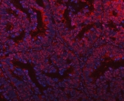 Immunofluorescent staining of FFPE human intestinal cancer tissue with PLEKHG5 antibody (red) and DAPI nuclear stain (blue). HIER: steam section in pH8 EDTA buffer for 20 min.