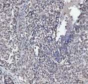 IHC staining of FFPE human poorly differentiated adenocarcinoma of the ovary with PLEKHG5 antibody. HIER: boil tissue sections in pH8 EDTA for 20 min and allow to cool before testing.