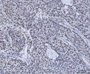 IHC staining of FFPE human non-small-cell lung carcinoma tissue with PLEKHG5 antibody. HIER: boil tissue sections in pH8 EDTA for 20 min and allow to cool before testing.