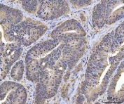 IHC staining of FFPE human colorectal adenocarcinoma tissue with PLEKHG5 antibody. HIER: boil tissue sections in pH8 EDTA for 20 min and allow to cool before testing.