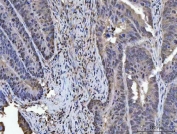 IHC staining of FFPE human colorectal adenocarcinoma tissue with PLEKHG5 antibody. HIER: boil tissue sections in pH8 EDTA for 20 min and allow to cool before testing.