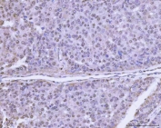 IHC staining of FFPE human liver cancer tissue with PLEKHG5 antibody. HIER: boil tissue sections in pH8 EDTA for 20 min and allow to cool before testing.