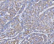 IHC staining of FFPE human liver cancer tissue with PLXDC2 antibody. HIER: boil tissue sections in pH8 EDTA for 20 min and allow to cool before testing.