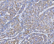 IHC staining of FFPE human liver cancer tissue with PLXDC2 antibody. HIER: boil tissue sections in pH8 EDTA for 20 min and allow to cool before testing.