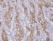 IHC staining of FFPE human lymphoma tissue with PLXDC2 antibody. HIER: boil tissue sections in pH8 EDTA for 20 min and allow to cool before testing.
