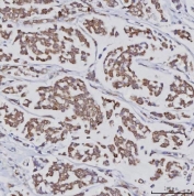 IHC staining of FFPE human breast cancer tissue with PLXDC2 antibody. HIER: boil tissue sections in pH8 EDTA for 20 min and allow to cool before testing.