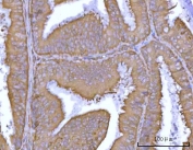 IHC staining of FFPE human endometrioid adenocarcinoma tissue with TRAILR2 antibody. HIER: boil tissue sections in pH8 EDTA for 20 min and allow to cool before testing.