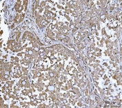 IHC staining of FFPE human lung cancer tissue with TRAILR2 antibody. HIER: boil tissue sections in pH8 EDTA for 20 min and allow to cool before testing.