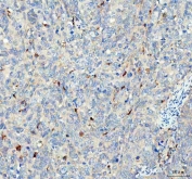 IHC staining of FFPE human cervical squamous carcinoma tissue with Glutathione Peroxidase 1 antibody. HIER: boil tissue sections in pH8 EDTA for 20 min and allow to cool before testing.