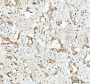 IHC staining of FFPE human prostatic acinar adenocarcinoma tissue with Glutathione Peroxidase 1 antibody. HIER: boil tissue sections in pH8 EDTA for 20 min and allow to cool before testing.