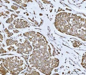 IHC staining of FFPE human breast cancer tissue with TAPP-1 antibody. HIER: boil tissue sections in pH8 EDTA for 20 min and allow to cool before testing.