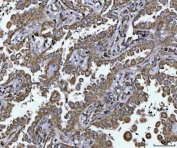 IHC staining of FFPE human lung cancer tissue with TAPP-1 antibody. HIER: boil tissue sections in pH8 EDTA for 20 min and allow to cool before testing.