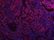 Immunofluorescent staining of FFPE human lung cancer tissue with TAPP-1 antibody (red) and DAPI nuclear stain (blue). HIER: steam section in pH8 EDTA buffer for 20 min.