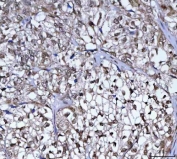 IHC staining of FFPE human invasive urothelial carcinoma of the bladder with squamous differentiation with TAPP-1 antibody. HIER: boil tissue sections in pH8 EDTA for 20 min and allow to cool before testing.