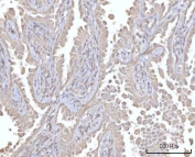 IHC staining of FFPE human lung adenocarcinoma tissue with PRDM15 antibody. HIER: boil tissue sections in pH8 EDTA for 20 min and allow to cool before testing.