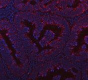 Immunofluorescent staining of FFPE human intestinal cancer tissue with PRDM15 antibody (red) and DAPI nuclear stain (blue). HIER: steam section in pH8 EDTA buffer for 20 min.