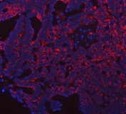 Immunofluorescent staining of FFPE human ovarian cancer tissue with PRDM15 antibody (red) and DAPI nuclear stain (blue). HIER: steam section in pH8 EDTA buffer for 20 min.