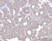IHC staining of FFPE human ovary serous carcinoma tissue with PRDM15 antibody. HIER: boil tissue sections in pH8 EDTA for 20 min and allow to cool before testing.