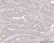 IHC staining of FFPE human rectum adenocarcinoma tissue with PRDM15 antibody. HIER: boil tissue sections in pH8 EDTA for 20 min and allow to cool before testing.