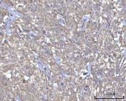 IHC staining of FFPE human urothelial carcinoma tissue with PRDM15 antibody. HIER: boil tissue sections in pH8 EDTA for 20 min and allow to cool before testing.