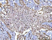 IHC staining of FFPE human lymphoma tissue with POLR1B antibody. HIER: boil tissue sections in pH8 EDTA for 20 min and allow to cool before testing.
