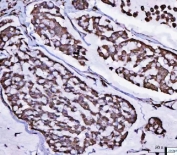 IHC staining of FFPE human breast cancer tissue with POLR1B antibody. HIER: boil tissue sections in pH8 EDTA for 20 min and allow to cool before testing.