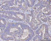 IHC staining of FFPE human colorectal adenocarcinoma tissue with Renin antibody. HIER: boil tissue sections in pH8 EDTA for 20 min and allow to cool before testing.