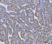 IHC staining of FFPE human thyroid papillary carcinoma tissue with B-cell lymphoma/leukemia 11B antibody. HIER: boil tissue sections in pH8 EDTA for 20 min and allow to cool before testing.